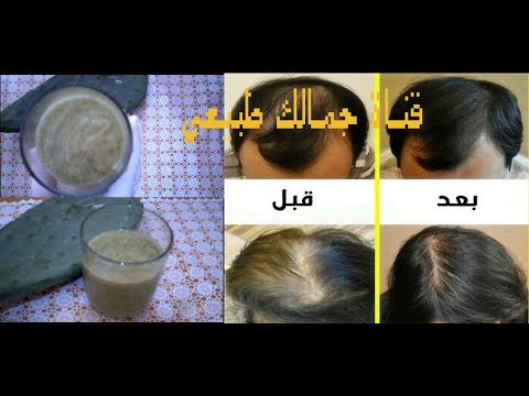 إنبات الشعر داخل الفراغات وعلاج الصلع نهائيًا